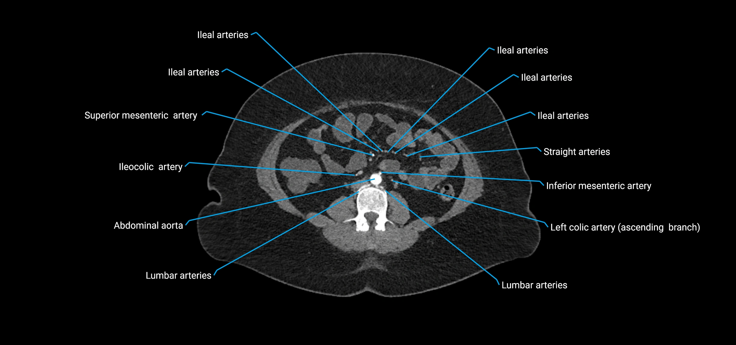 CTA abdomen axial cross sectional anatomy labelled image_112 (2).webp